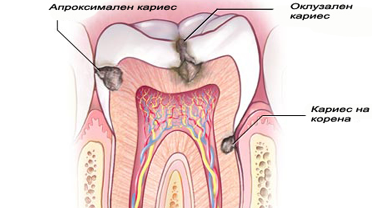 Лечение на Кариес