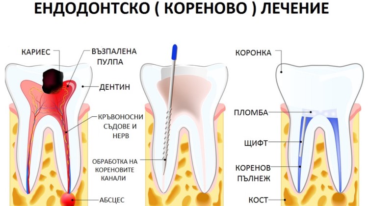 Кореново Лечение(Ендодонтско)