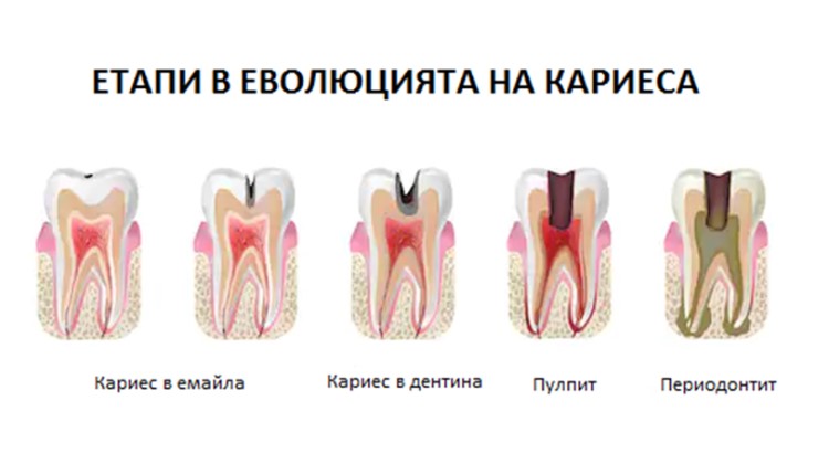 Лечение на Пулпит